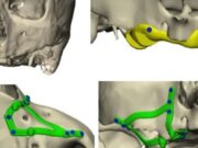 La innovació tecnològica revoluciona la rehabilitació dental en pacients amb pèrdua òssia extrema