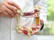 Fins a la meitat dels casos de càncer colorectal es poden evitar